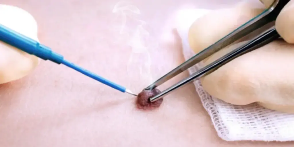 Cautery Skin Treatment in Perth, Australia - Victa Health