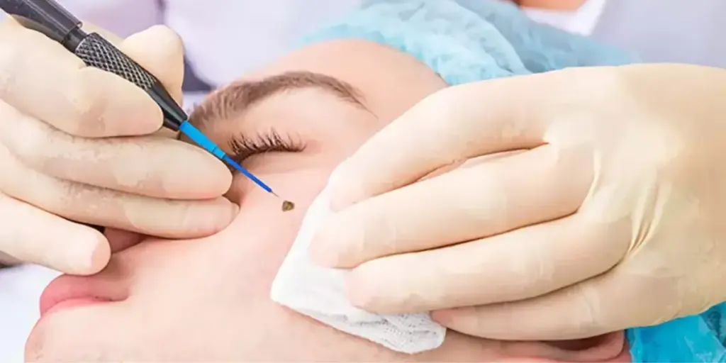 Expert Cautery Skin Treatment in Perth, Australia – Victa Health