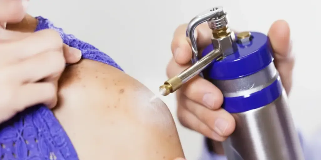 Expert Cryotherapy Skin Treatment in Perth, Australia – Victa Health