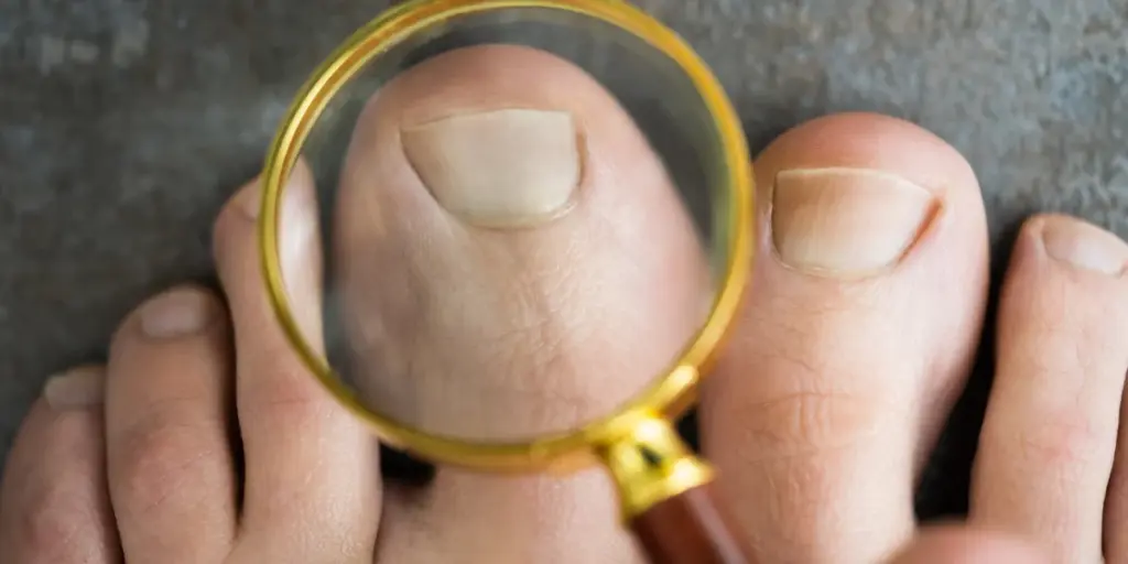 Expert Ingrown Toenail Surgery in Perth_ Fast Relief from Pain & Infection- victa Health