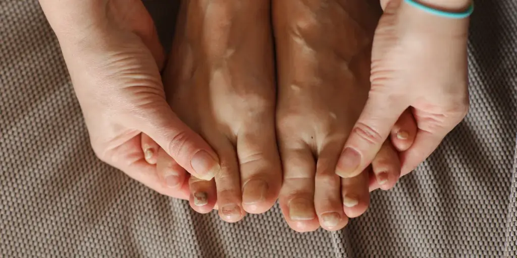 Ingrown Toenail Removal Surgery in Perth_ Procedure, Recovery & Results- Victa Health