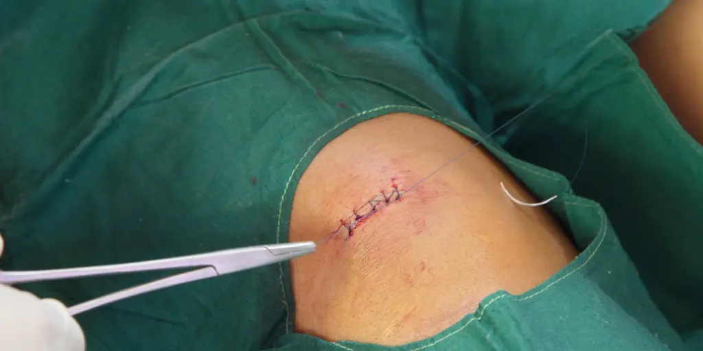 Professional Wound Suturing in Perth_ When Stitches Are Needed & What to Expect - Victa Health