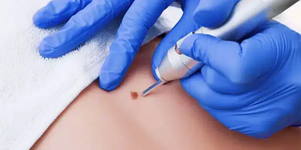 Skin Lesion Removal in Perth_ What to Expect at Victa Health
