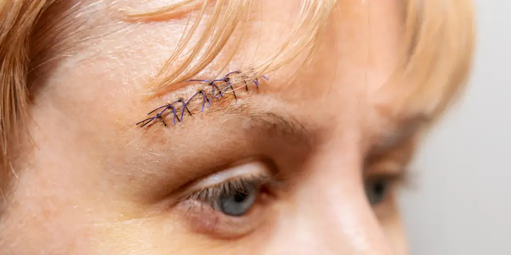 Trusted Wound Suturing Services in Perth, Australia – Victa Health